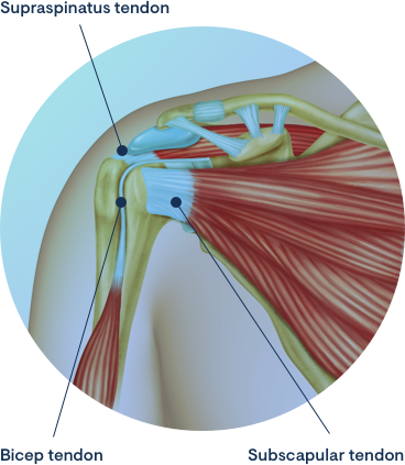 Tendonitis of the Shoulder (Tendonitis of the Rotator Cuff)